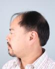 Before Hair Transplant&nbsp;Front